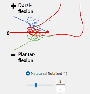 3. Metatarsal Rotation